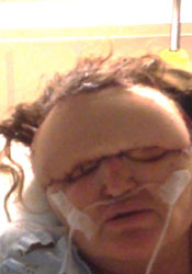 Case - Carol after surgery