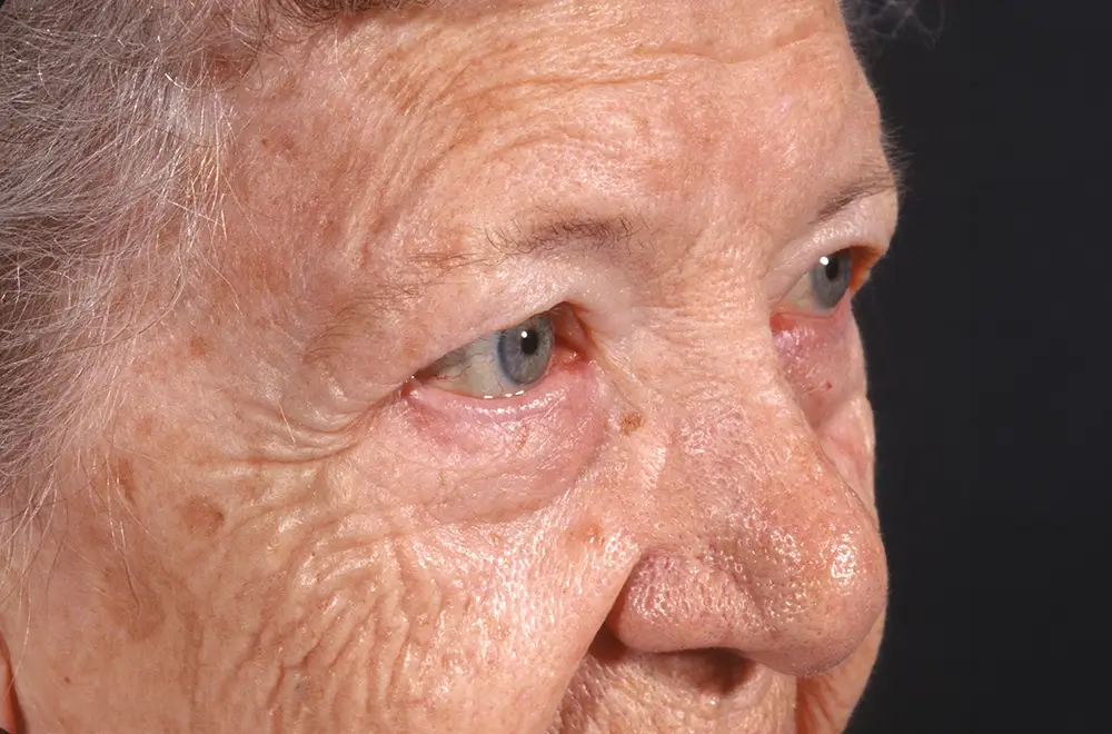 Blepharoplasty--2760 | Before Blepharoplasty 3