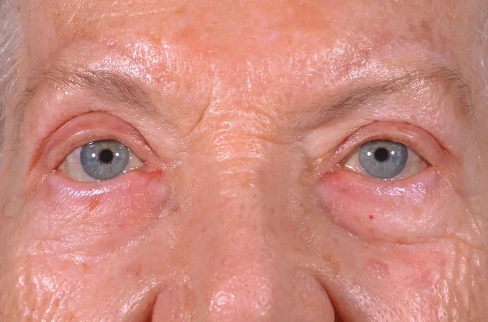 Blepharoplasty--2760 | After Blepharoplasty 1