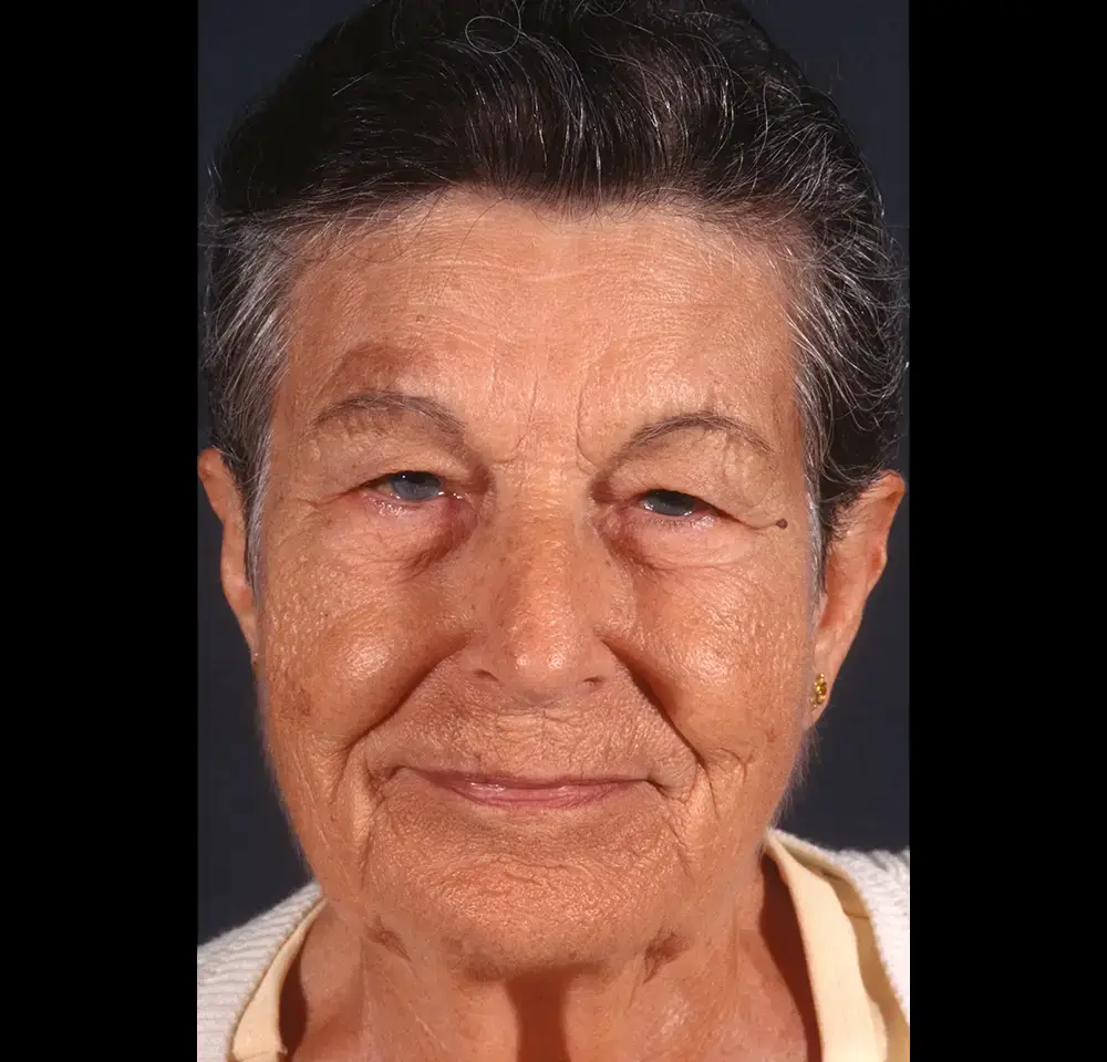 Blepharoplasty--5971 | Before Blepharoplasty 4