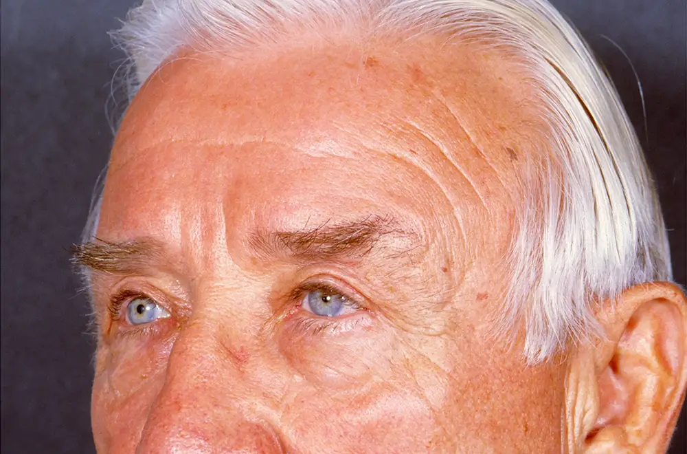 Blepharoplasty--3684 | After Blepharoplasty 2