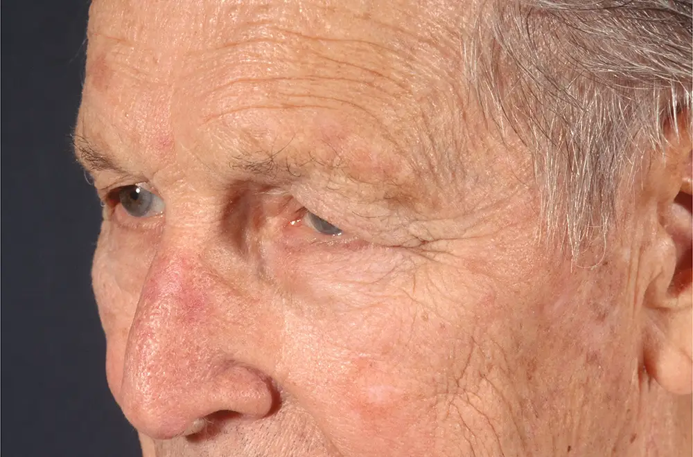 Blepharoplasty--6819 | Before Blepharoplasty 2