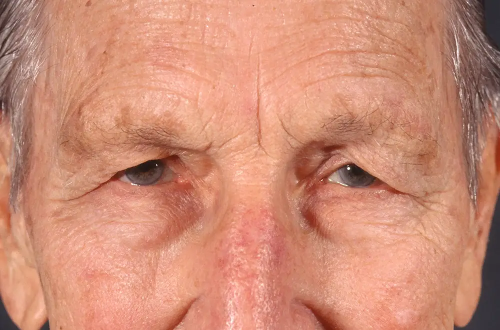 Blepharoplasty--6819 | Before Blepharoplasty 1