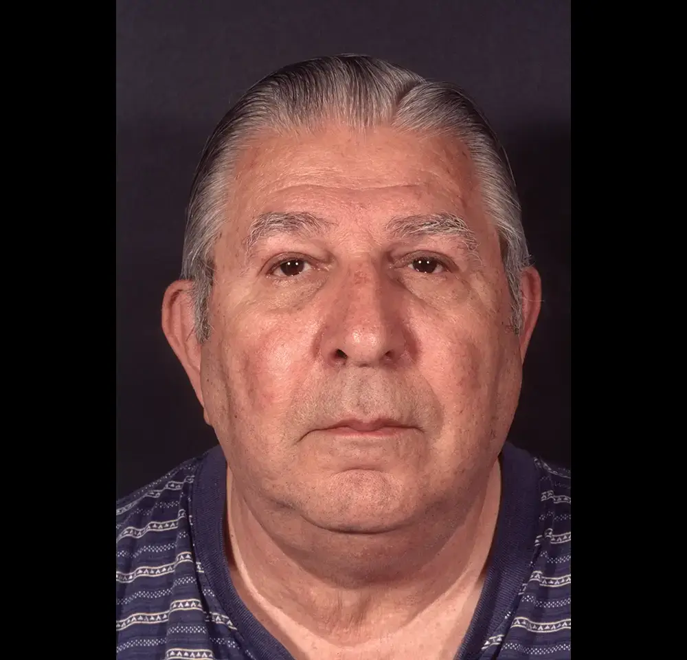 Blepharoplasty--9009 | After Blepharoplasty 4