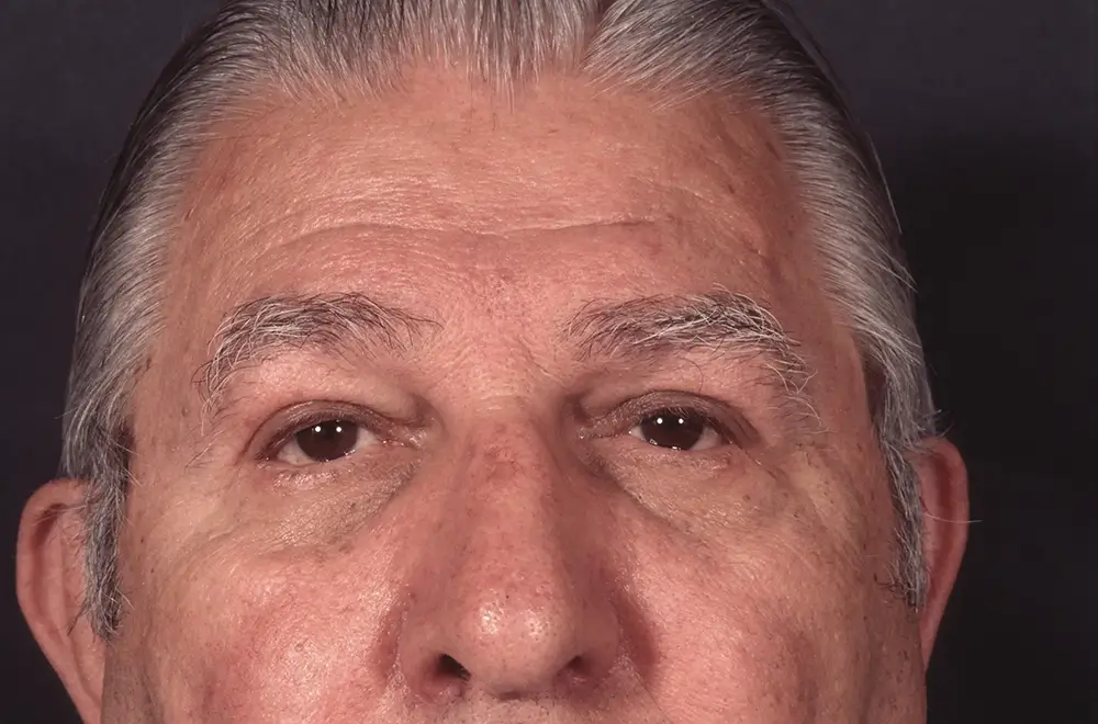 Blepharoplasty--9009 | After Blepharoplasty 1