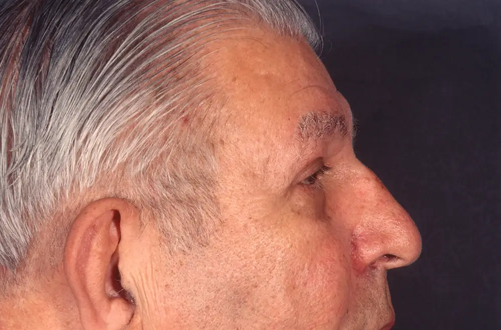 Blepharoplasty--9009 | After Blepharoplasty 3