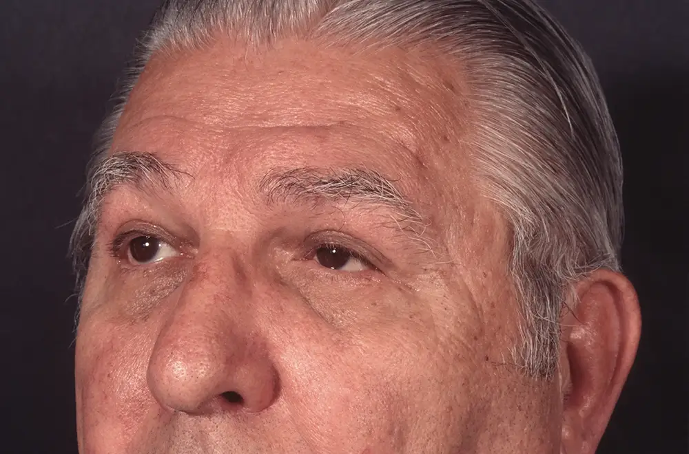 Blepharoplasty--9009 | After Blepharoplasty 2
