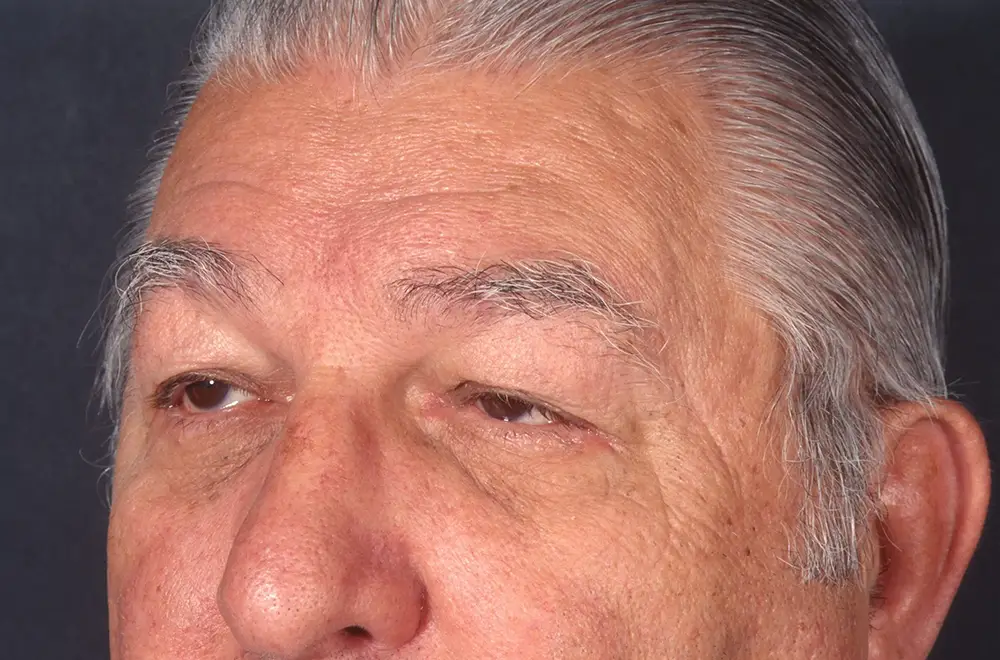 Blepharoplasty--9009 | Before Blepharoplasty 2