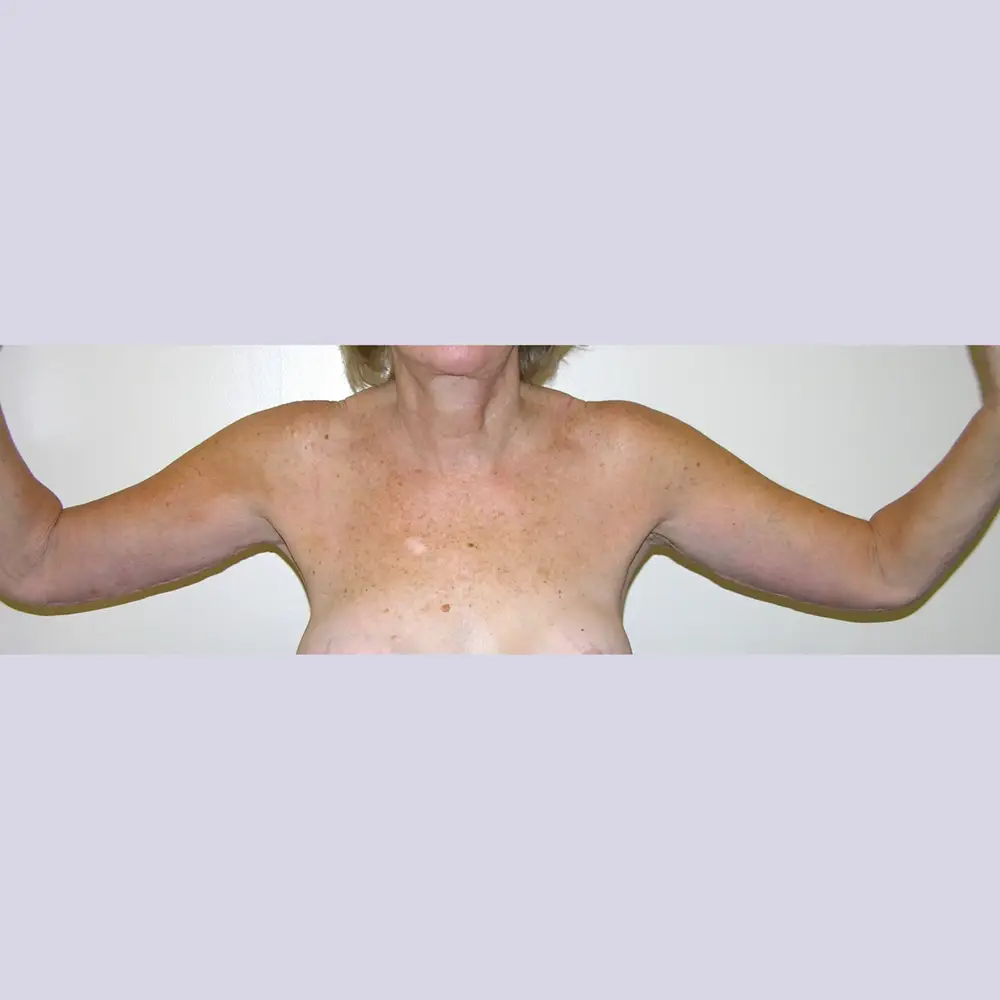 Arm-Lift--6637 | After Arm Lift