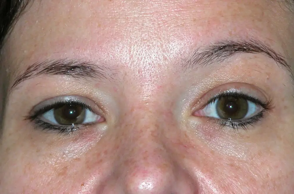 Blepharoplasty--7227 | Before Face