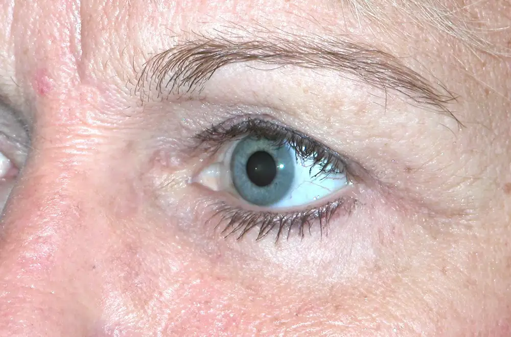 Blepharoplasty--3196 | After Blepharoplasty 2