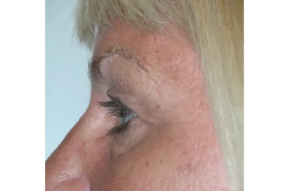 Blepharoplasty--3196 | Before Blepharoplasty 3