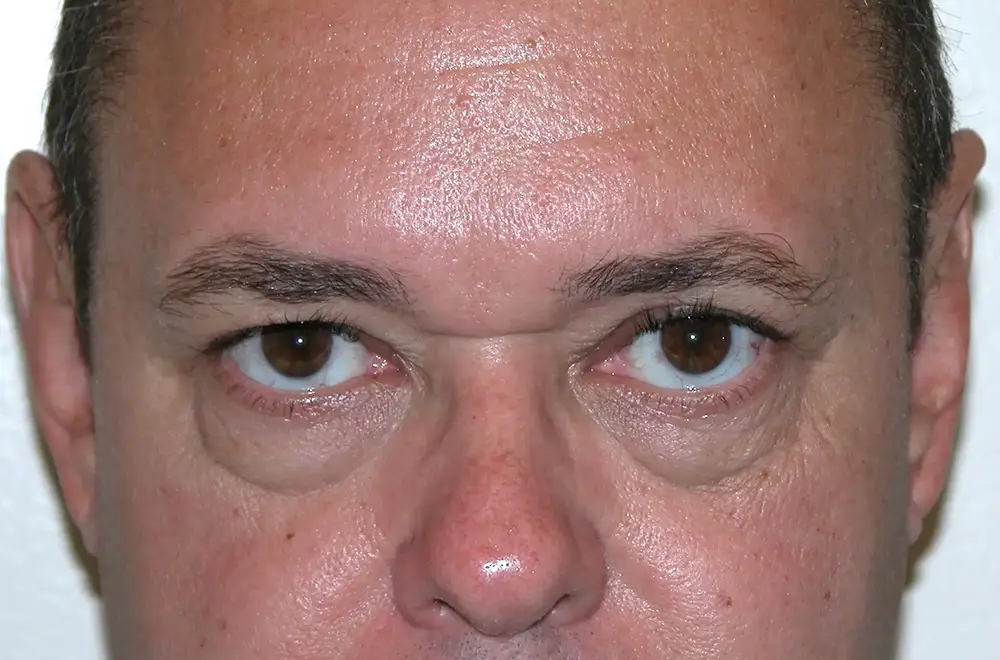 Blepharoplasty--5504 | After Face