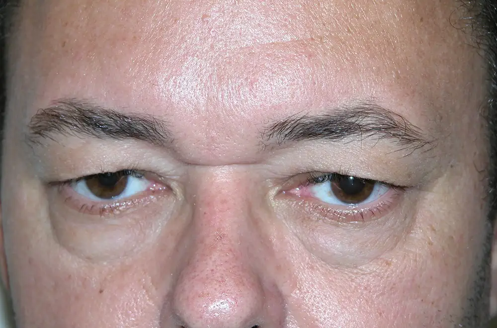 Blepharoplasty--5504 | Before Face