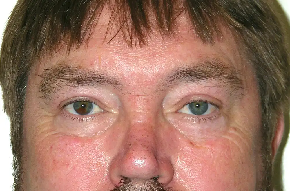 Blepharoplasty--1576 | After Blepharoplasty 1