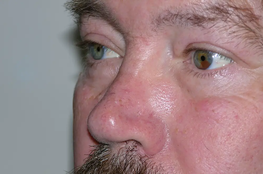 Blepharoplasty--1576 | After Blepharoplasty 3