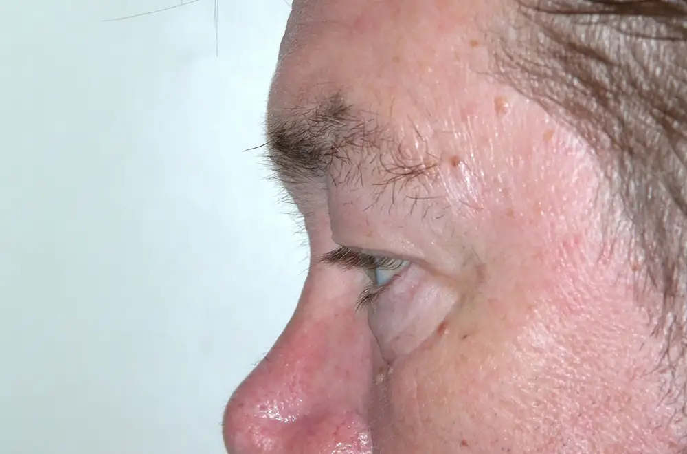 Blepharoplasty--1576 | Before Blepharoplasty 2