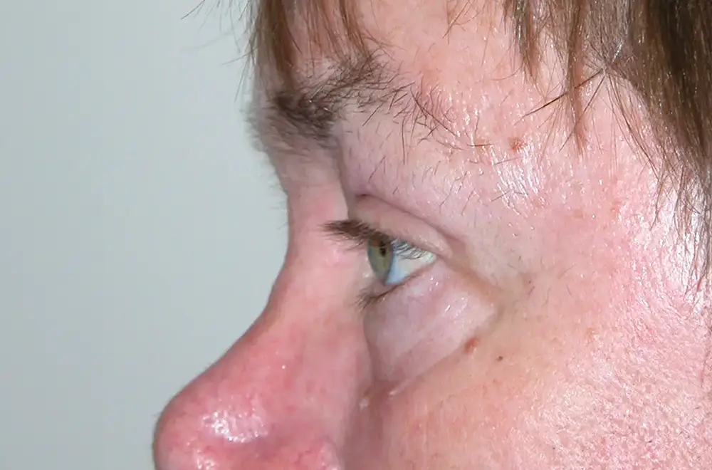 Blepharoplasty--1576 | After Blepharoplasty 2
