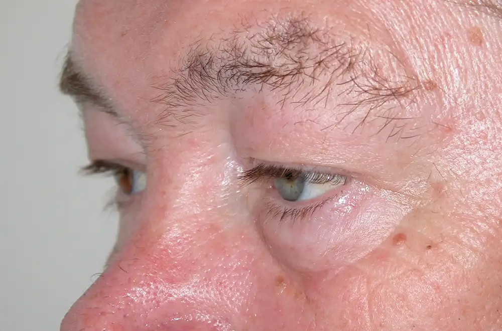 Blepharoplasty--1576 | Before Blepharoplasty 3