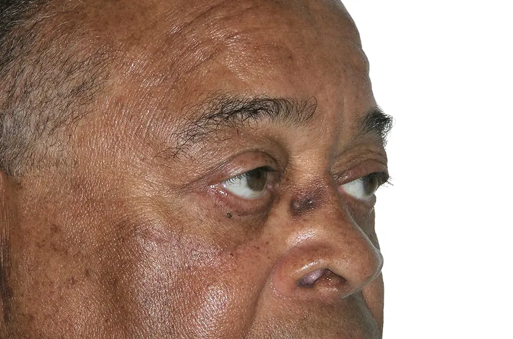 Blepharoplasty--5465 | After Blepharoplasty 2