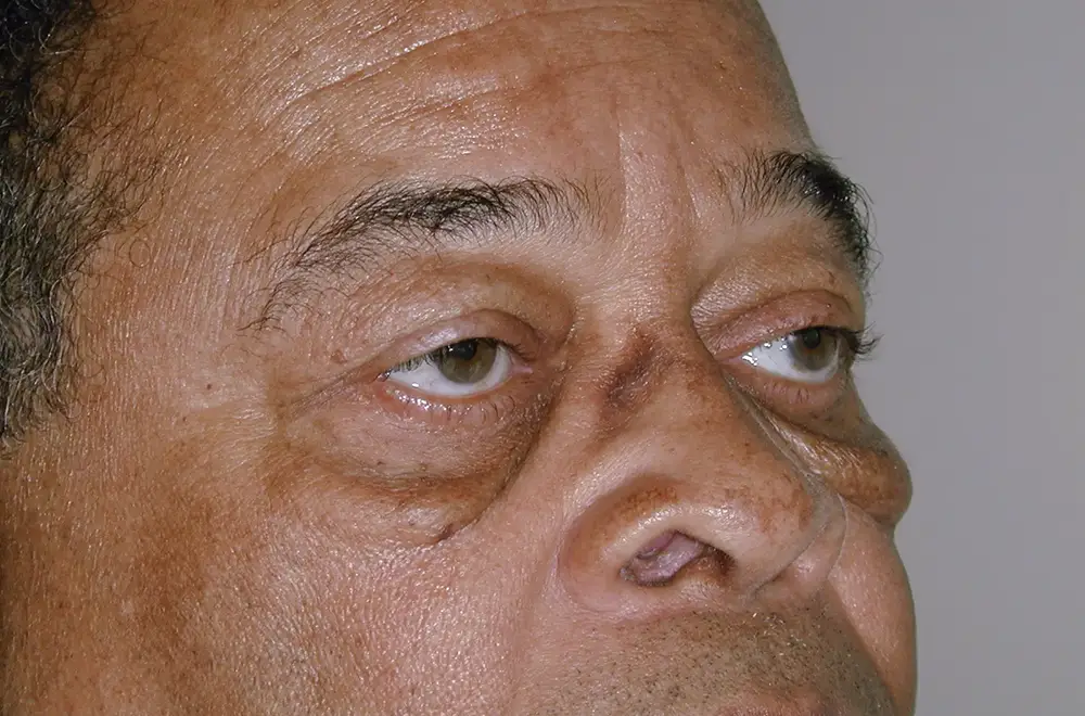 Blepharoplasty--5465 | Before Blepharoplasty 2