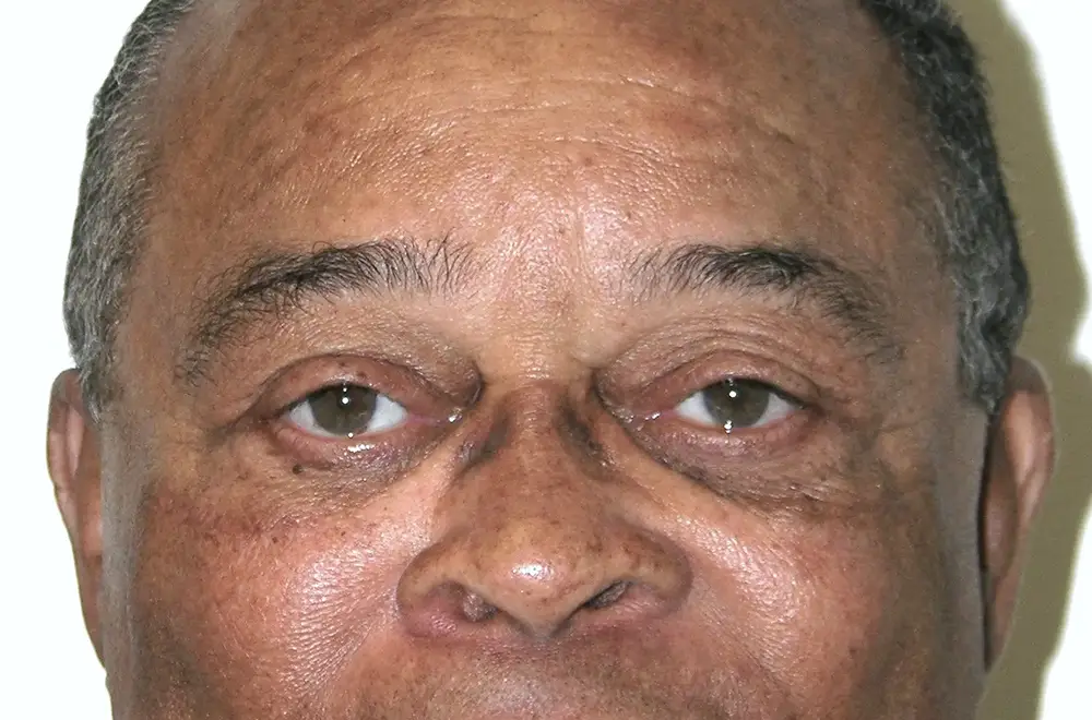 Blepharoplasty--5465 | After Blepharoplasty 1