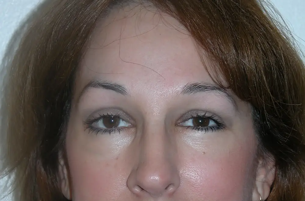Blepharoplasty--1108 | After Blepharoplasty