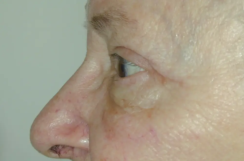 Blepharoplasty--1941 | After Blepharoplasty 2