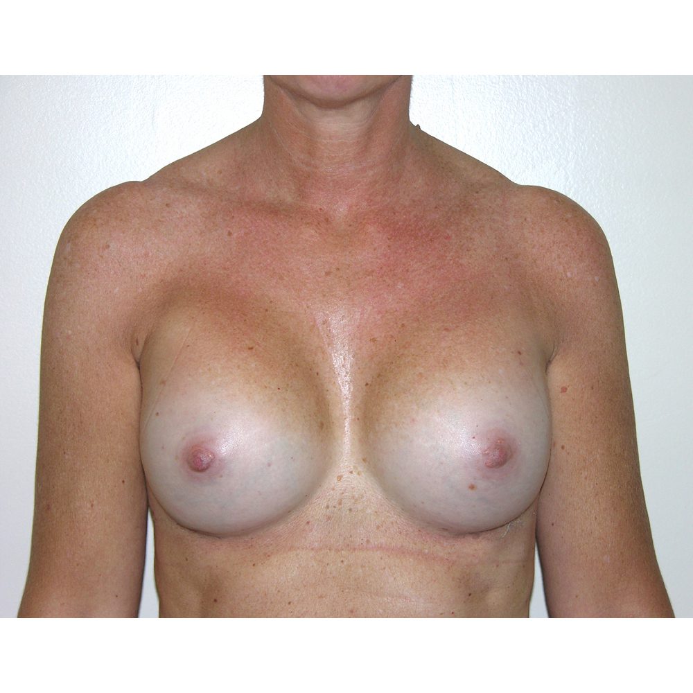 Breast-Augmentation--7666 | After Breast Augmentation 1