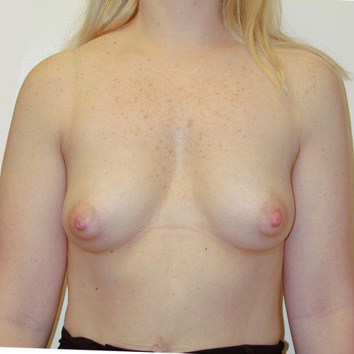 Breast-Augmentation--7350 | Before Breast Augmentation 1