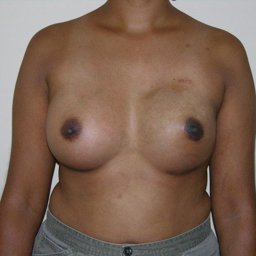 Breast-Reconstruction--7776 | After Breast Reconstruction 1