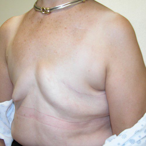 Breast-Reconstruction--2771 | Before Breast Reconstruction 2