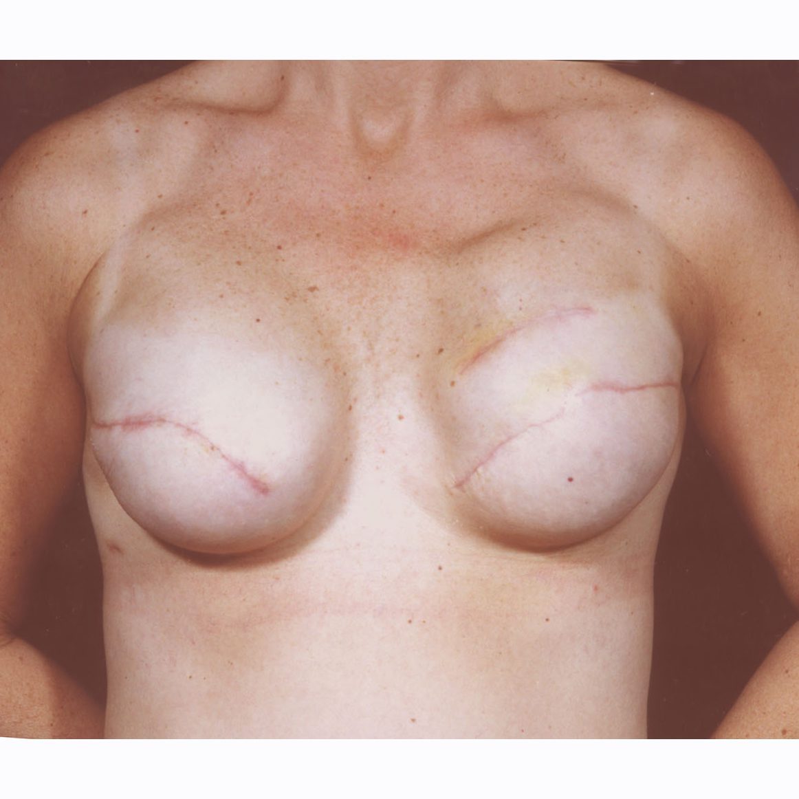 Breast-Reconstruction--5208 | Before Breast Reconstruction 3
