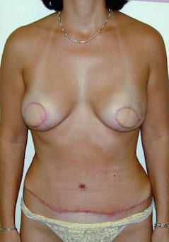 Breast-Reconstruction--8987 | After Breast Reconstruction
