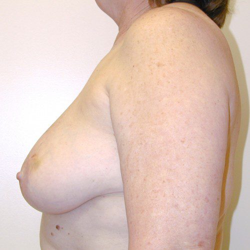 Breast-Reconstruction--9855 | Before Breast Reconstruction 3