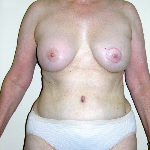 Breast-Reconstruction--3790 | After Breast Reconstruction 1