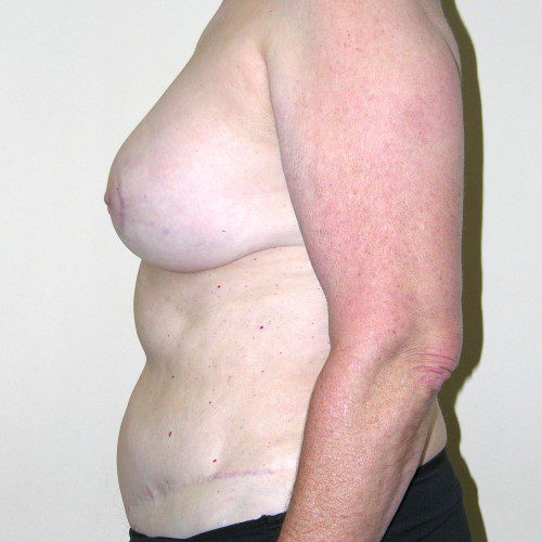 Breast-Reconstruction--3790 | After Breast Reconstruction 3