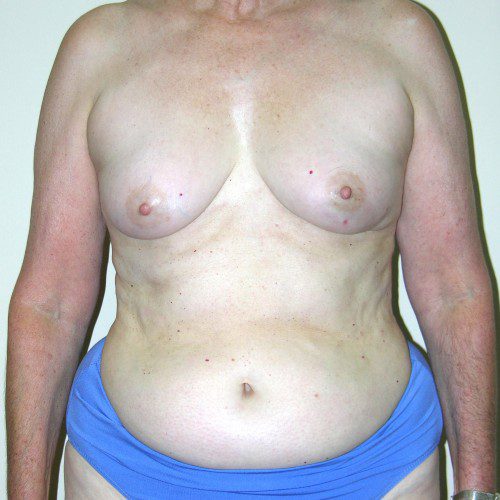 Breast-Reconstruction--3790 | Before Breast Reconstruction 1