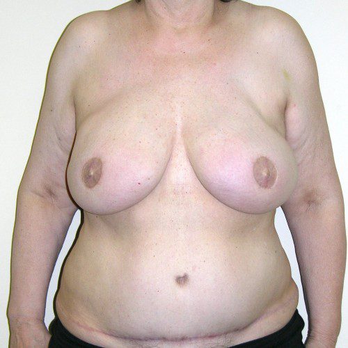 Breast-Reconstruction--4788 | After Breast Reconstruction 1