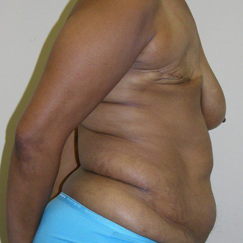 Breast-Reconstruction--6593 | Before Breast Reconstruction 3