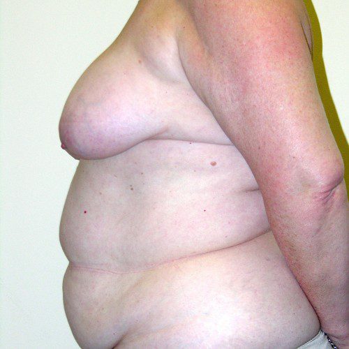Breast-Reconstruction--7775 | Before Breast Reconstruction 3
