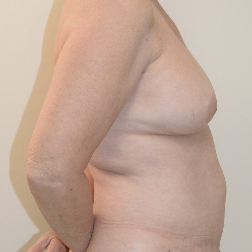Breast-Reconstruction--9835 | After Breast Reconstruction 3