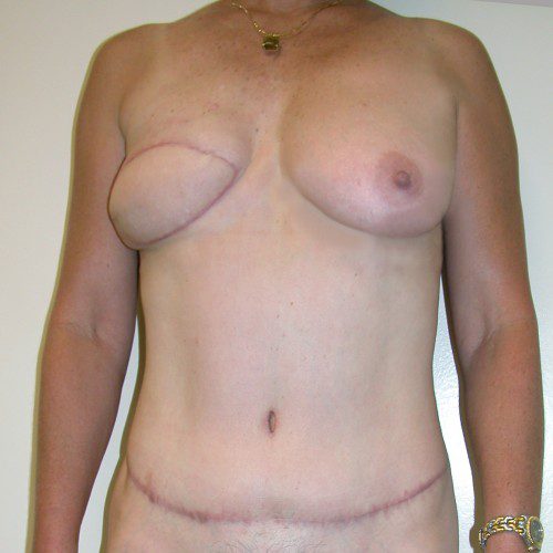 Breast-Reconstruction--6733 | After Breast Reconstruction