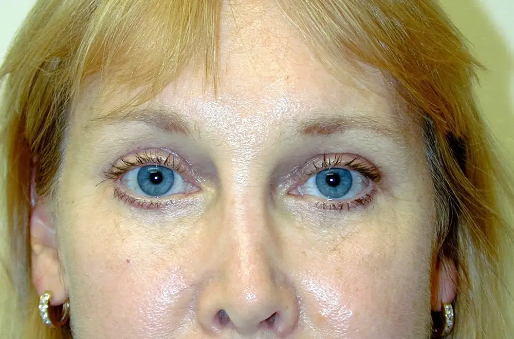 Blepharoplasty--6765 | After Blepharoplasty 1