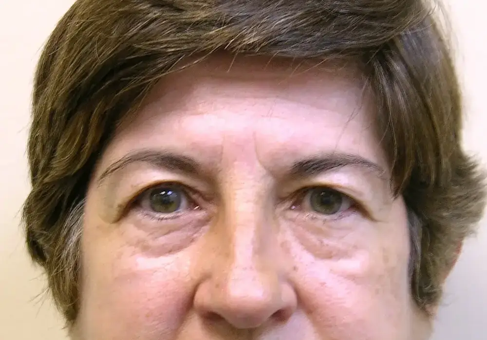 Brow-Lift--8081 | Before Brow Lift