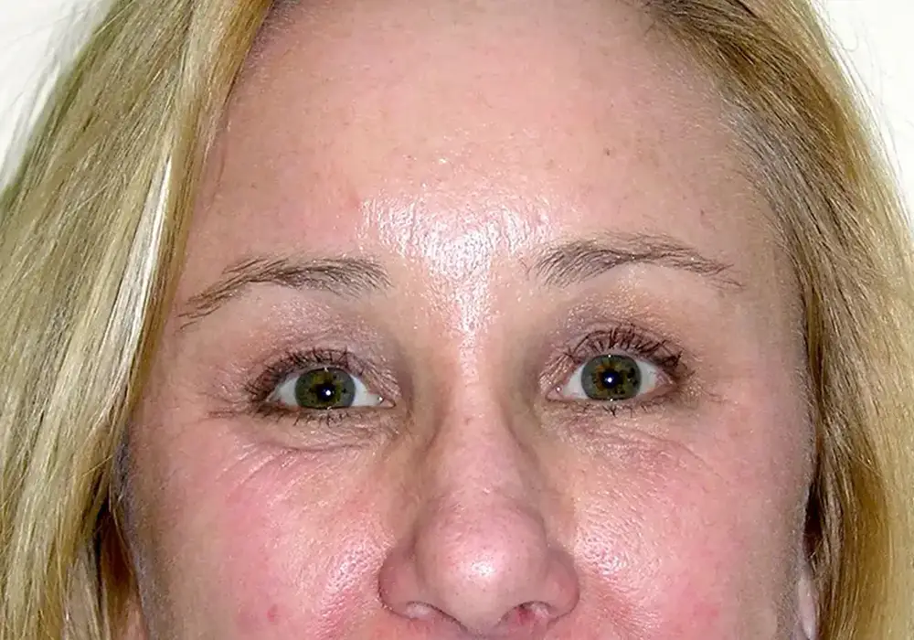 Brow-Lift--7463 | After Brow Lift 1