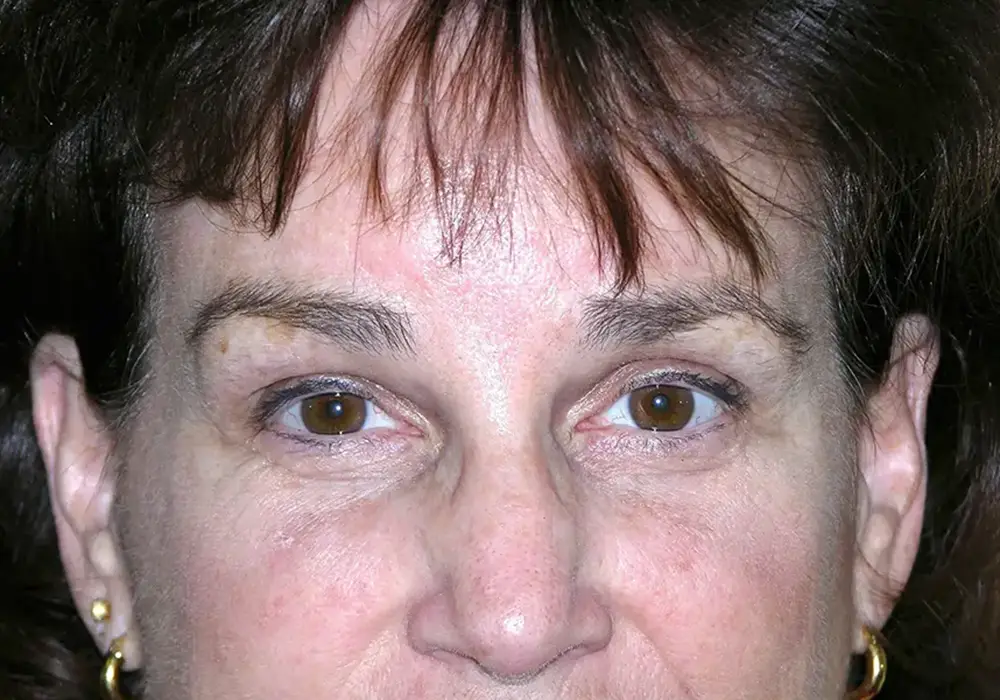 Brow-Lift--7201 | After Brow Lift 1
