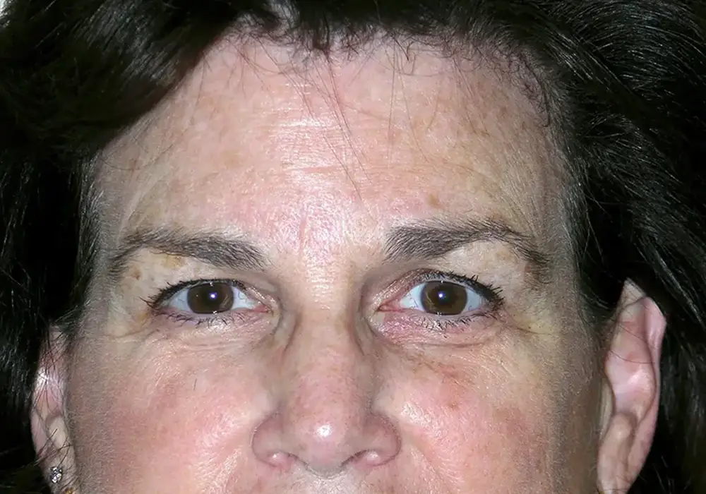 Brow-Lift--7201 | Before Brow Lift 1