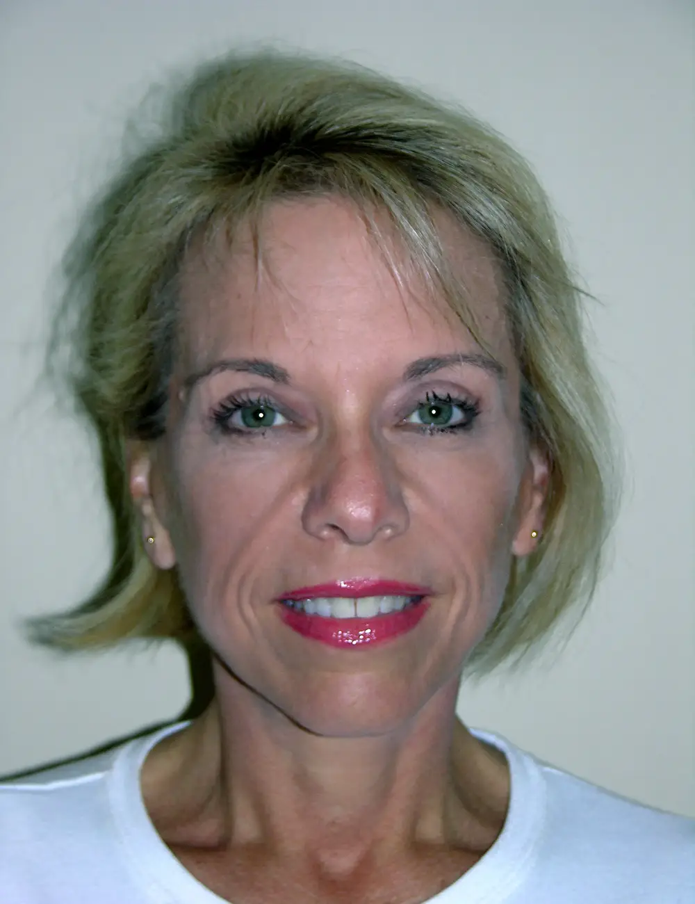 Brow-Lift--7592 | Before Brow Lift