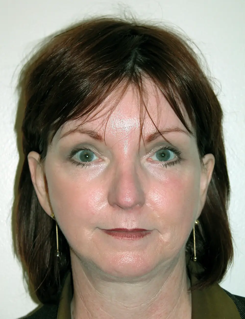 Brow-Lift--5227 | After Brow Lift